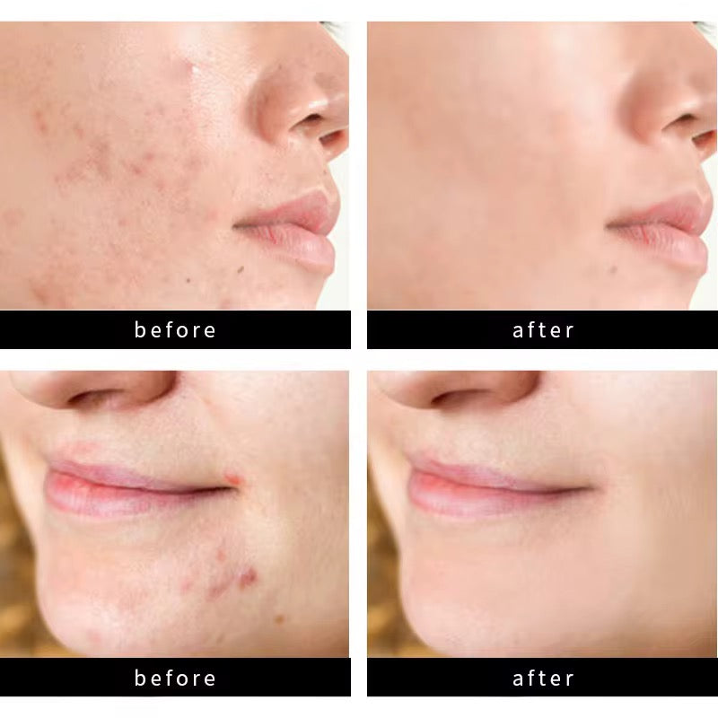 Acne Patch