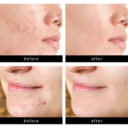 Acne Patch